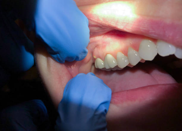 Best Root Canal Emergency Dentist  in Hapeville, GA